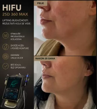 Hifu25D360maksaparatzaliftinglicaitelaNoviPazar61