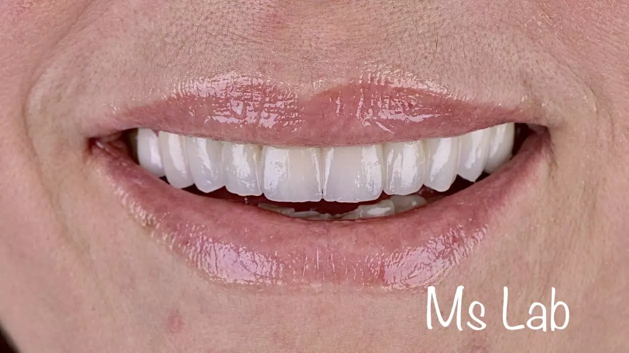 IzradaprotetskihradovaBeogradZvezdara1 IzradaprotetskihradovaBeogradZvezdara1