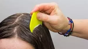 Otklanjanje-vaški-i-gnjida-Stari-grad4 Otklanjanje-vaški-i-gnjida-Stari-grad4