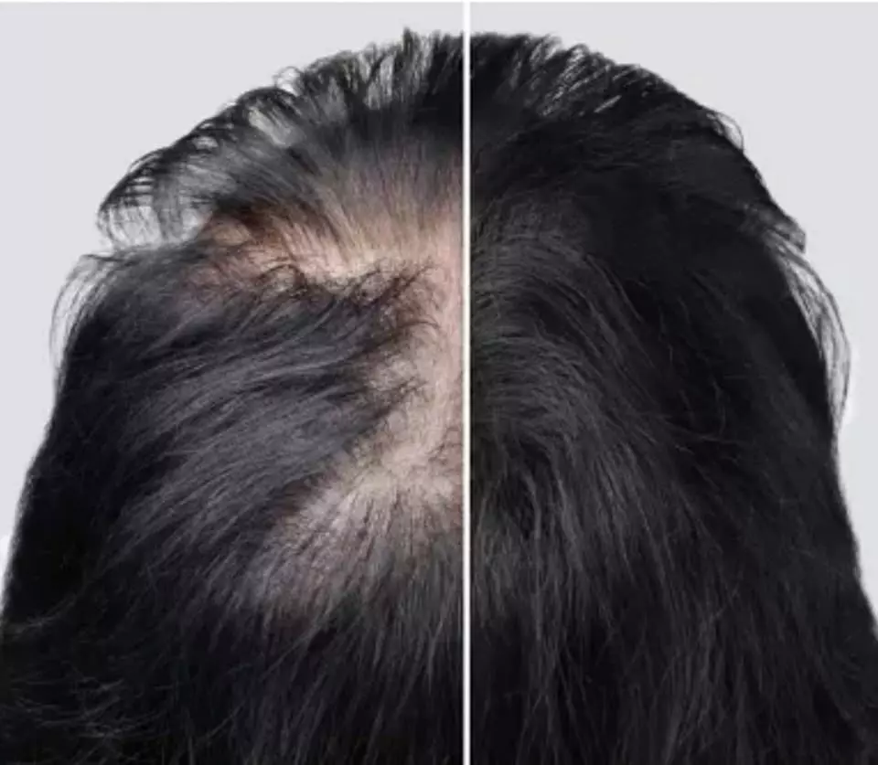 Transplantacija kose