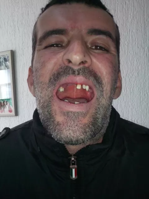 Specijalista proteticar Momir Durlevic Novi Sad  (48).jpg
