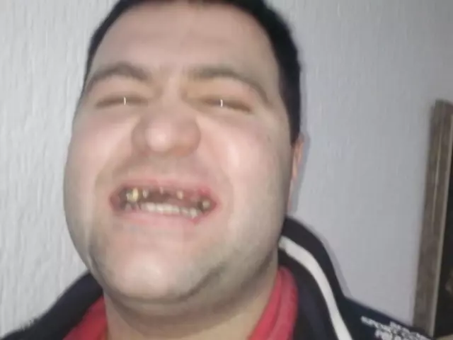 Specijalista proteticar Momir Durlevic Novi Sad  (60).jpg