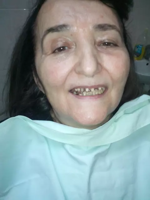 Specijalista proteticar Momir Durlevic Novi Sad  (75).jpg